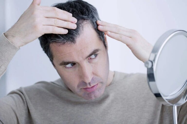8 Early Signs Of Balding in Men